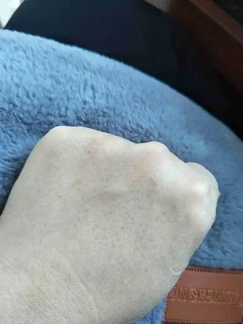 最近几个月手背上长了很多斑点?