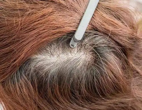 头皮头发根疼是怎么回事