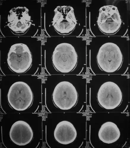 大家看看这双侧基底节区低密度影是什么病变?