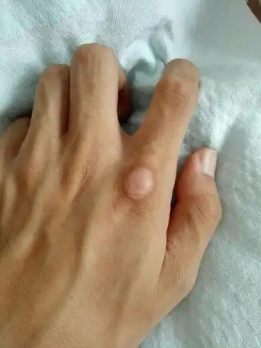 食指的末端关节处长了一个圆形的硬疙瘩 不痛不痒 按压也不痛 长了
