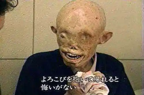 受到原子弹辐射的日本人