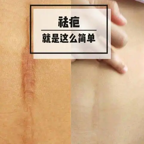 剖腹产疤痕怎么办产后妈妈看这里