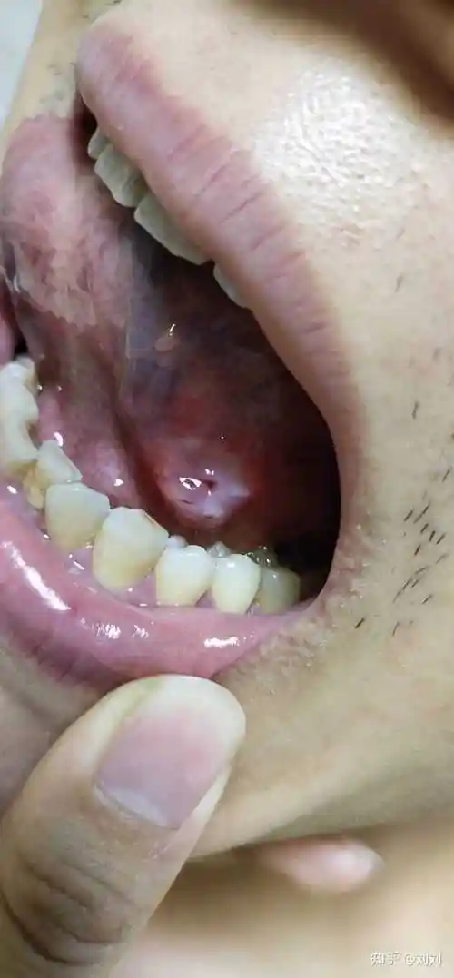 刘刘 的想法: 舌头下面有个泡 一个月了 谁知道是怎么回事 - 知乎