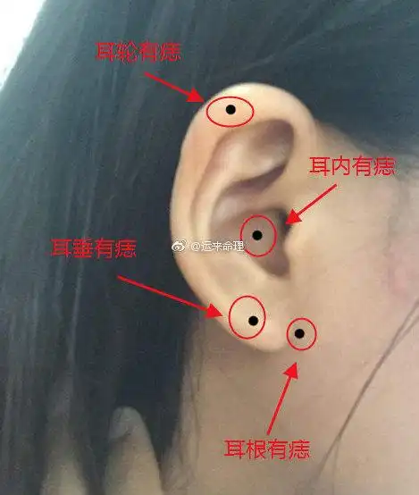 别看我们的耳朵不大但是不同位置上的痣带来的影响可是不一样的