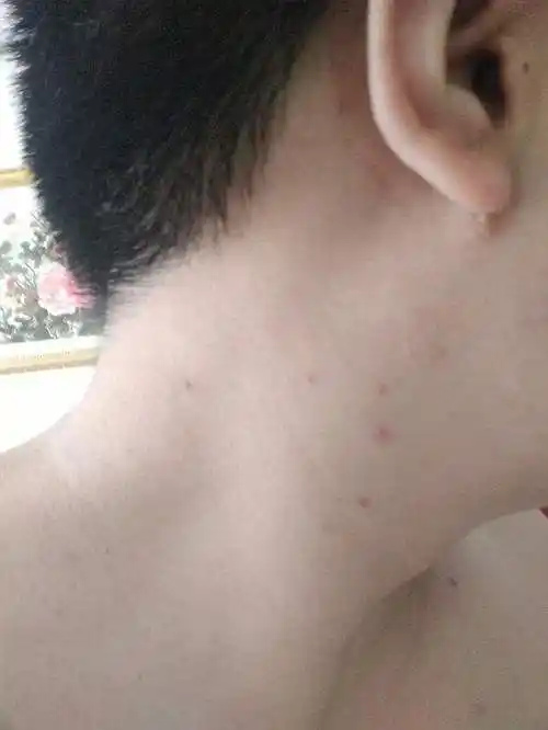 艾滋病颈部:淋巴结肿大