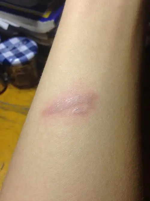 我被烙铁烫伤了,照片是烫伤情况,该怎么办啊