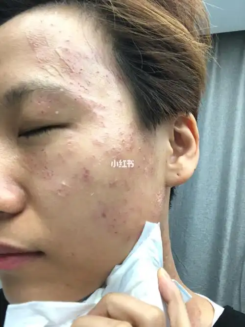 丝状疣祛除 #激光去疣 今天终于鼓起勇气把脖子上成片的丝状疣激光