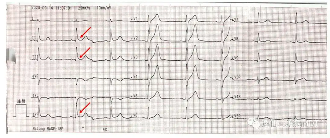 早期复极综合征如何鉴别良性or恶性一个病例帮你理清