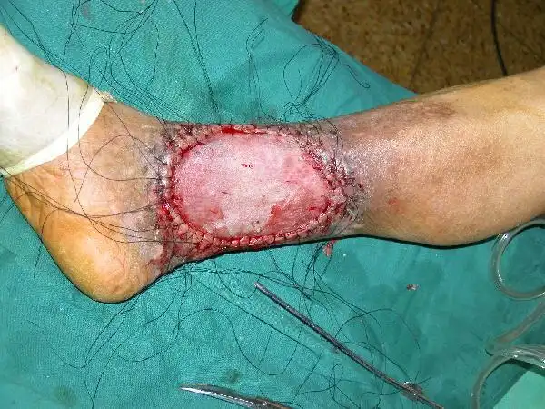 图3  同一患者,行右股内侧取皮(中厚皮片),右小腿溃疡游离植皮术(术中