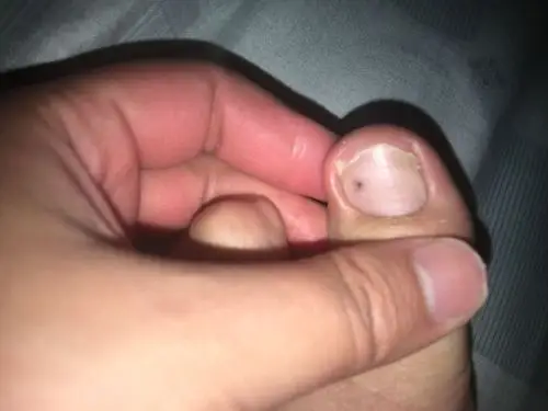 脚趾甲里面长了个黑斑,怎么回事?