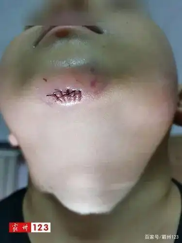 霸州一男童在一培训班内摔伤,当事双方协商陷入僵持