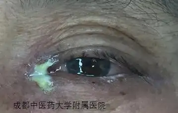 流泪,流脓——慢性泪囊炎是怎么回事?该怎么办?