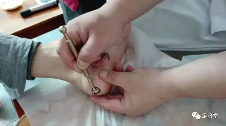 直肠癌患者肛门疼痛分分钟止痛附反射区讲解