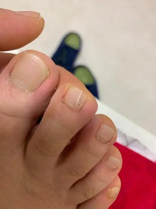 脚趾甲突然左右分了俩层,是怎么回事?