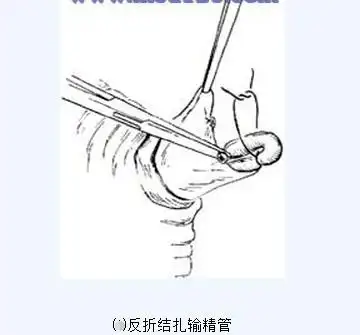 传说中的男性结扎手术全过程(附图), 做了真的会变成"太监"吗?