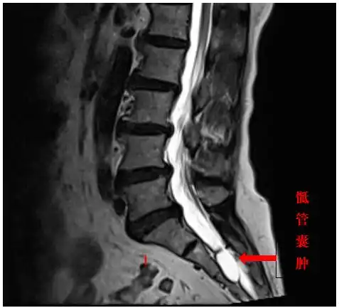 尾椎骨上的"水泡",真让人"上头"