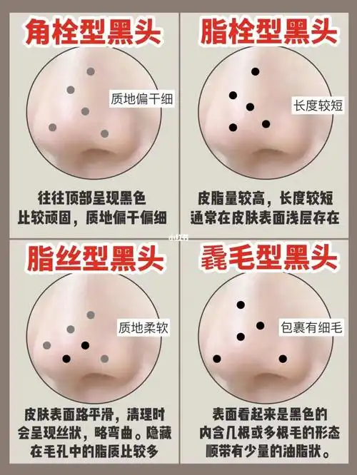 你属于哪种黑头油皮必看73进来抄作业