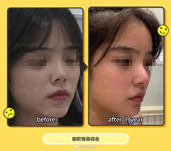 但太短也不好看,幼态感的脸延长鼻子要掌握好度,避免过长显老.