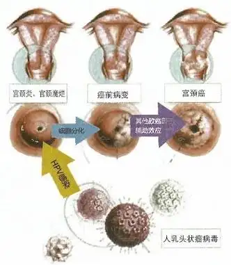 研究发现,宫颈癌的发生与人乳头瘤病毒(hpv)感染相关,患者99%以上都有