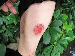 腿受伤流血真实图片