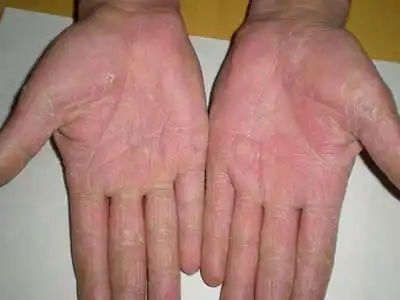 手足癣有着怎样的危害