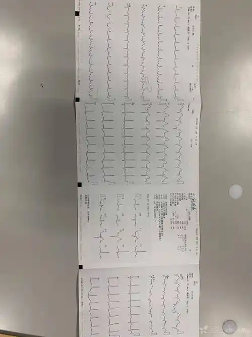 入院心电图检查