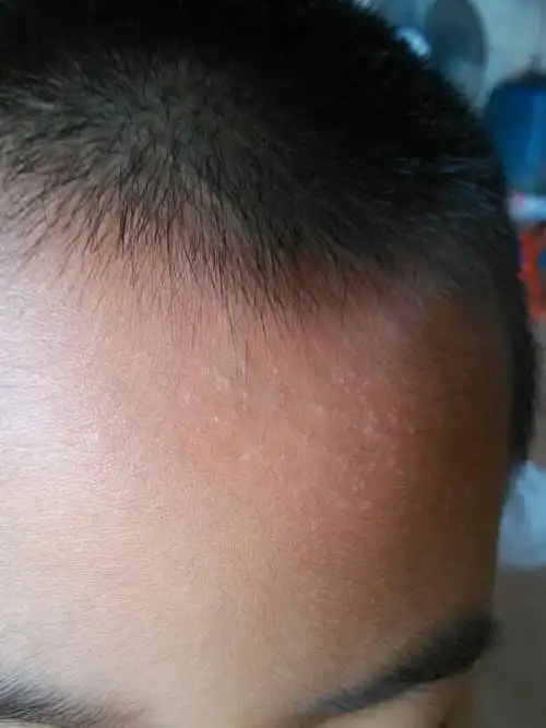 谁知道小孩额头长的小白点是什么?_百度宝宝知道