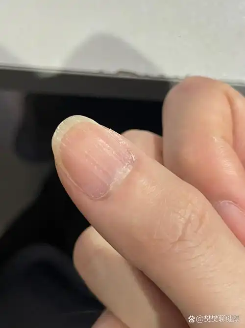 手指甲表面很多竖条纹