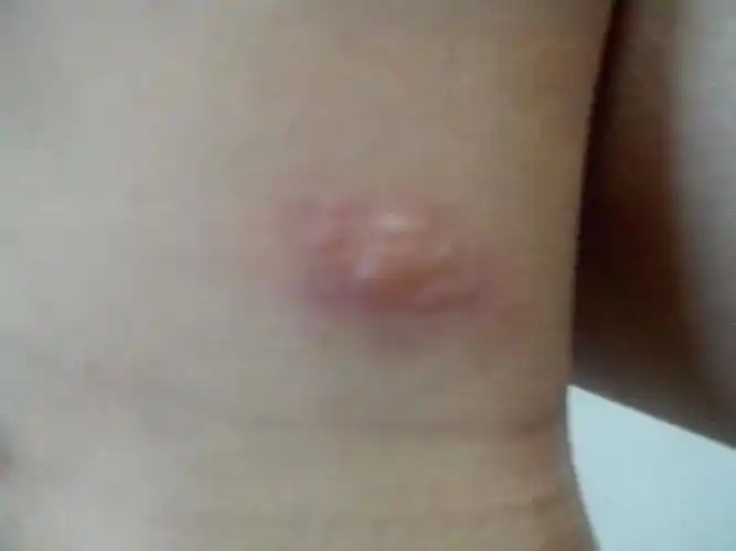 有点痒有点红 不知道这是什么 我本身也是过敏性皮炎 有人说是疱疹有