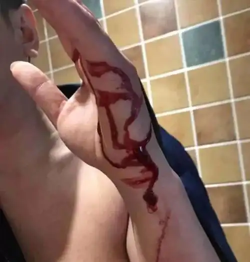 图为肖俊受伤的手.