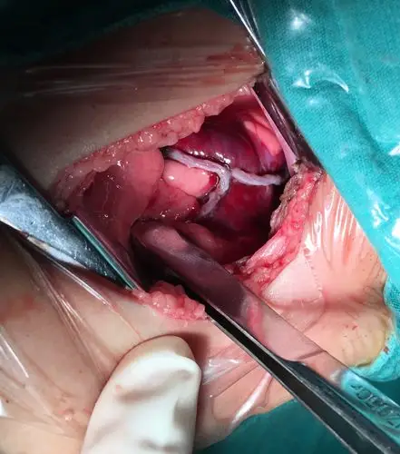 切除肺大泡标本,大小约10x8cm,如气球萎缩样手术时间约40分钟,过程