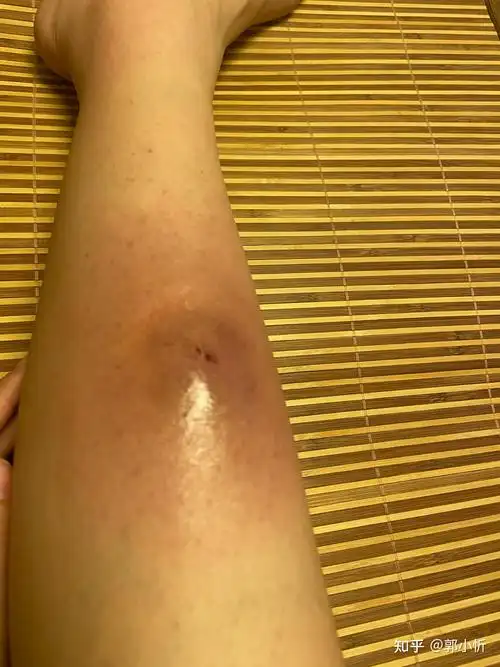 小腿火疖子从发展到切开全过程记录