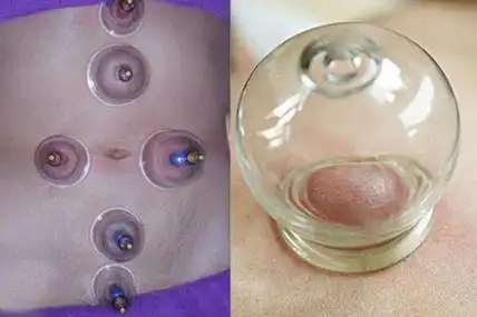 了解火罐减肥腹部位置图有没有什么副作用