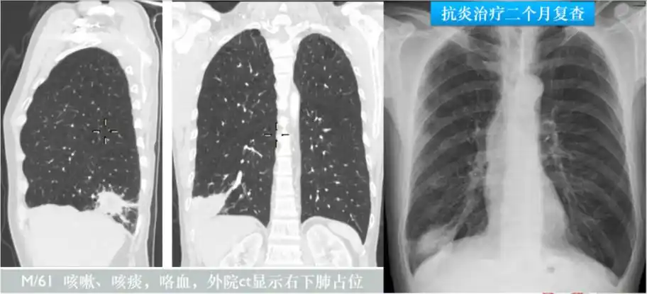 高莉教授:从呼吸科最常见的肺部感染基本影像,谈临床