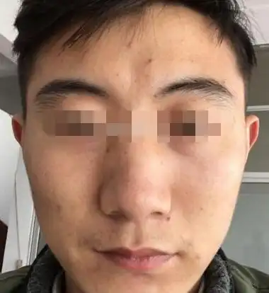 额头印堂附近也凹陷,所以30岁之前多也阻碍,心愿难达成.