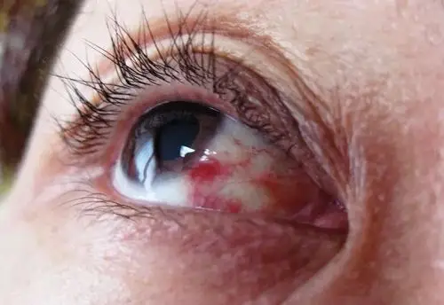 眼睛布满红血丝6大因素是元凶
