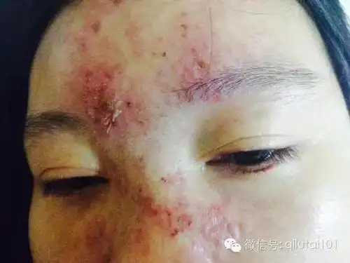 左眼失明左脑栓塞打个玻尿酸差点要了她的命