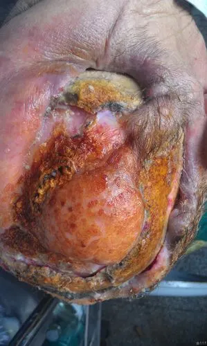 求治疗方案——全国首例基底细胞癌