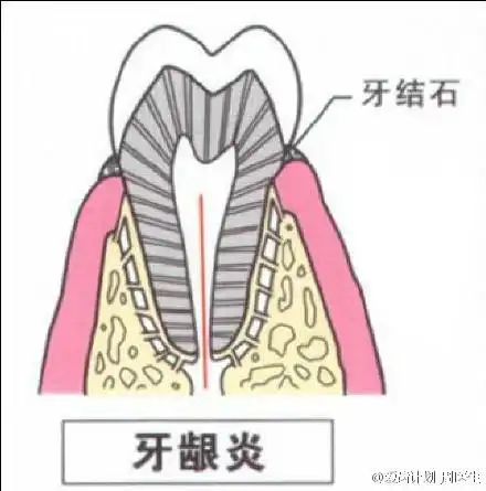 牙龈炎与牙周炎的区别