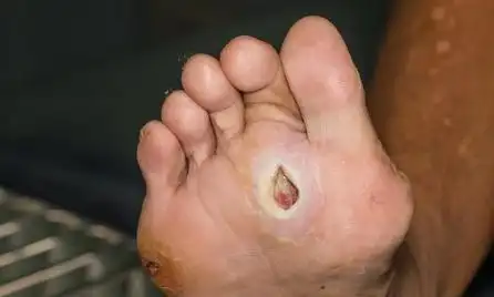 糖尿病足是每个糖友的噩梦出现3个症状就该警惕