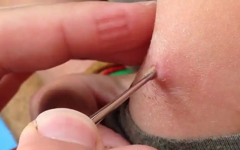 动物篇235虻叮咬重口慎入