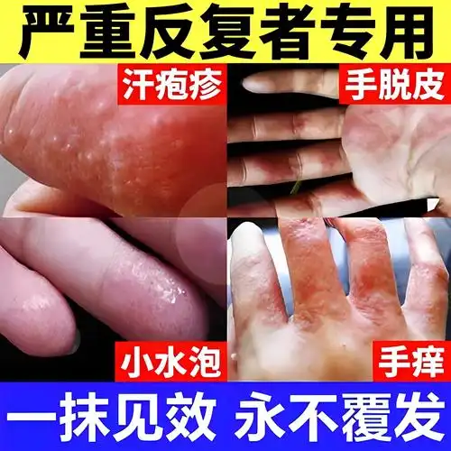 药膏汉状真菌感染手气膏-特价促销-优惠券领取-价格|多少钱|什么牌子