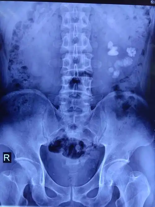 肾结石的微创治疗 【经皮肾镜钬激光碎石取石术】