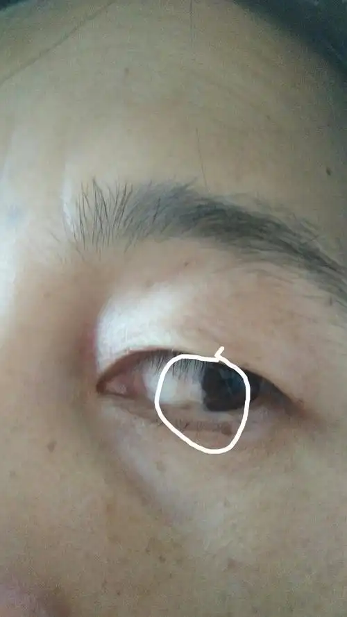 眼睛中不舒服,好想里面有白色的东西,怎么回事?