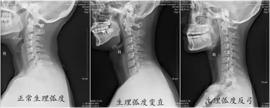 为什么颈椎生理曲度会变直会有什么严重后果吗
