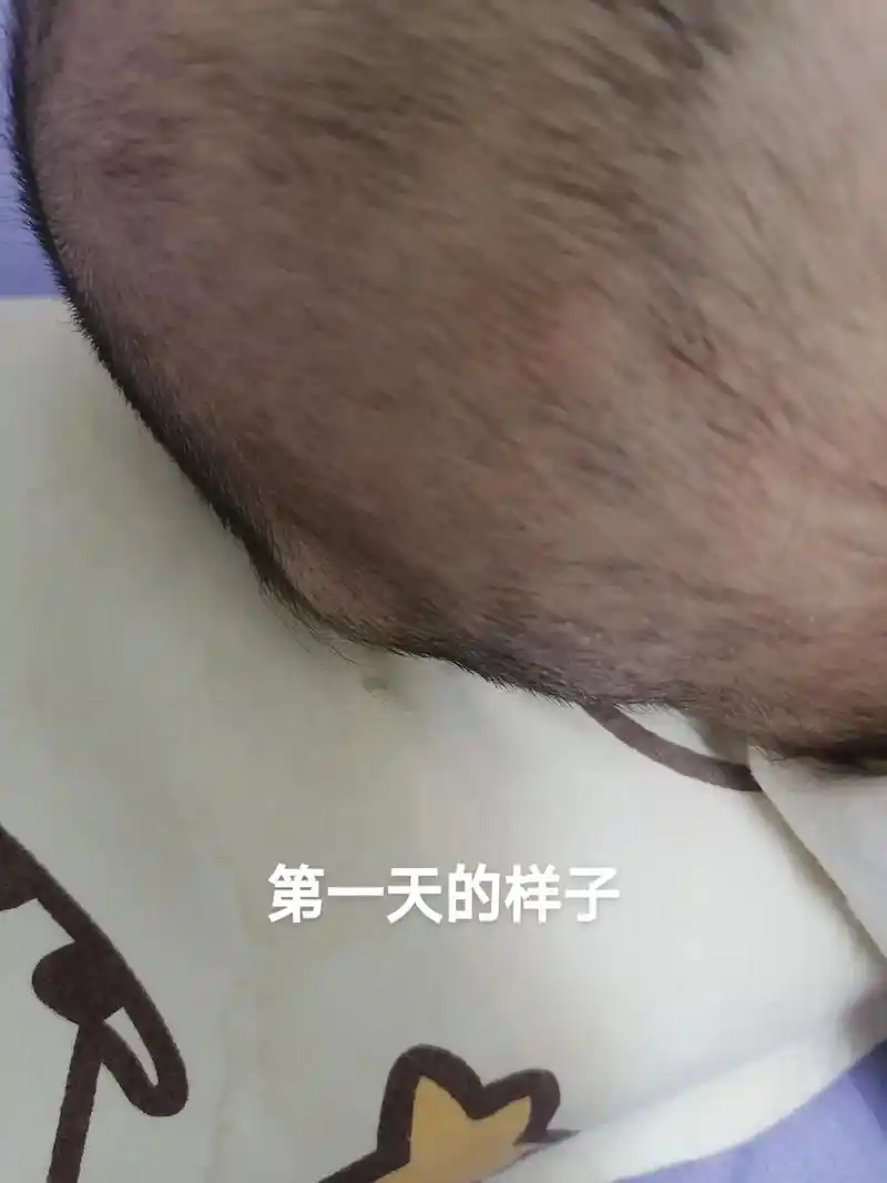 宝宝七个多月,没有摔没有磕碰,忽然后脑勺起了一个大鼓包,去医 - 抖音