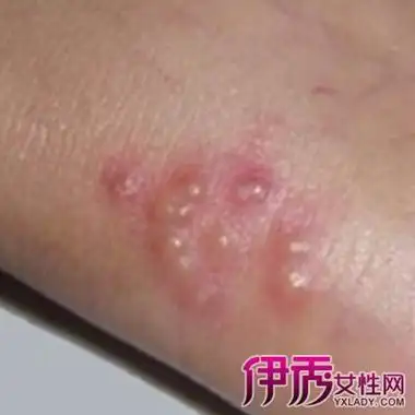 图女性尖锐湿疣初期症状图片了解常见的3种症状