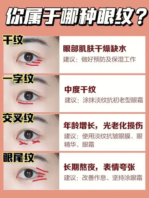 不同眼纹类型自救淡纹细纹千万不要慌