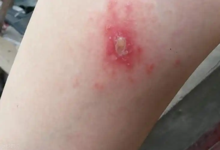 螨虫叮咬后的症状图(虫咬性皮炎的2个有效处理方法)-第4张图片-索考网