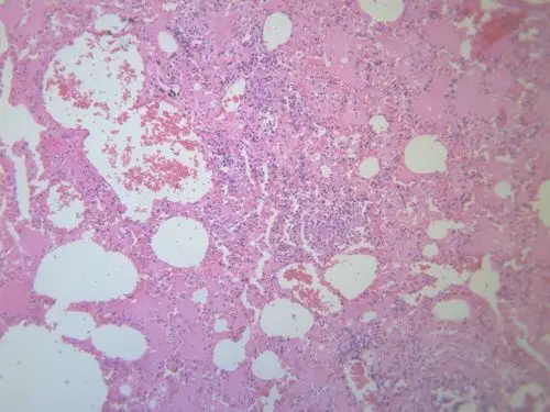 小叶性肺炎显微图片第17张